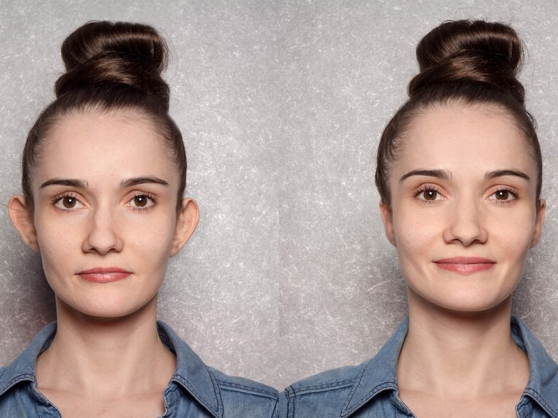 kepce-kulak-estetigi-otoplasti