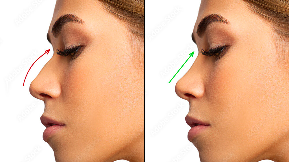 revizyon-burun-estetigi-page-img