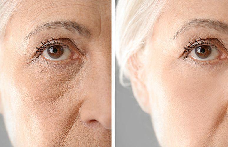 yuze-yag-enjeksiyonu-fiyatlari